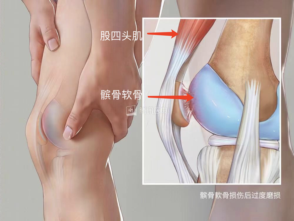 全民健身热潮下膝伤高发 白皮书呼吁运动防护与训练同等重要.docx